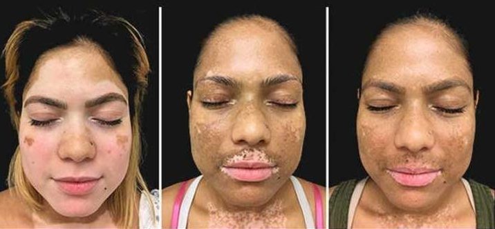 Mamacadela: um aliado natural no tratamento do vitiligo