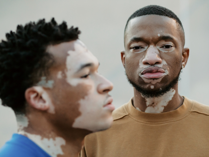 Como a camuflagem cosmética pode ajudar na autoestima de quem tem vitiligo