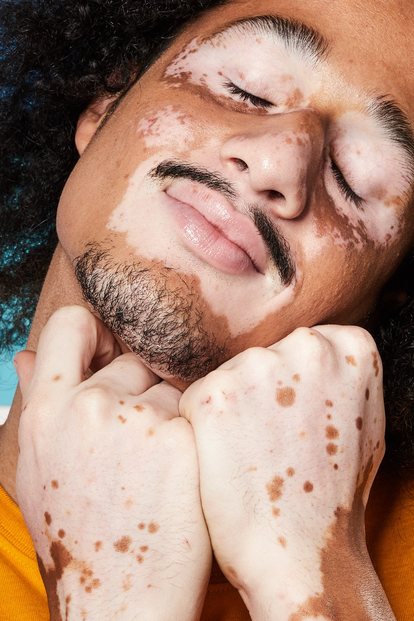 Procedimentos cirúrgicos para vitiligo: quando são indicados?