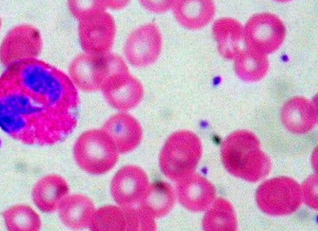 Guia Completo sobre Alergias e Eosinofilia