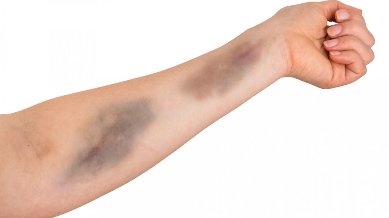 Como diferenciar equimose de hematoma: Guia completo