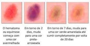 Equimoses pós-cirúrgicas: O que esperar e como cuidar