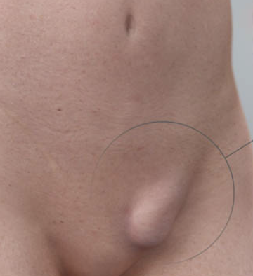 Guia completo sobre ISTs que causam íngua na virilha