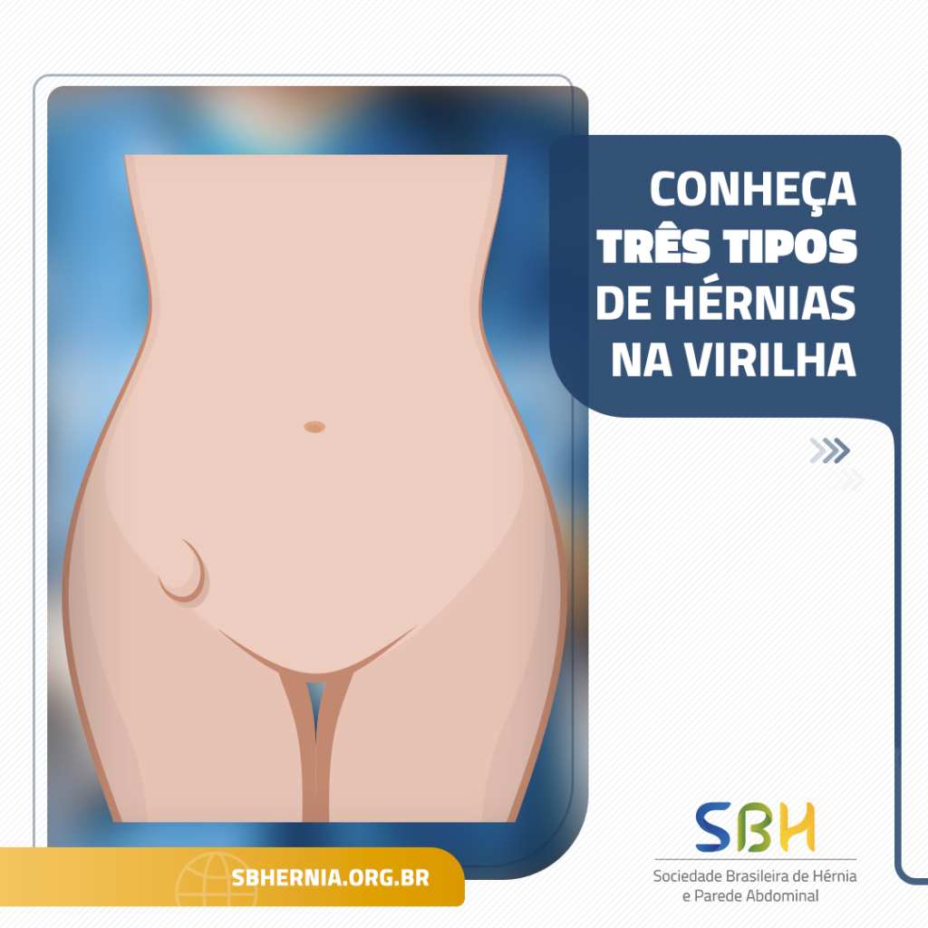 Foliculite na virilha: causas e tratamentos