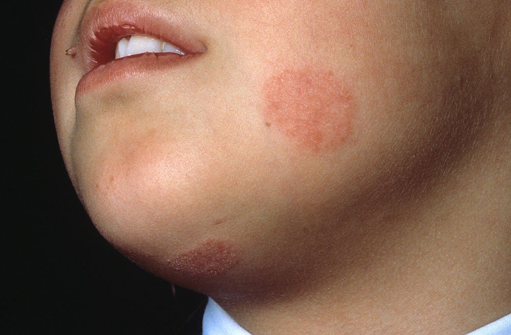 Os Melhores Cremes Antifúngicos para Cada Tipo de Micose