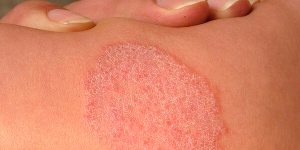 Micose em Crianças: Sinais e Cuidados Específicos