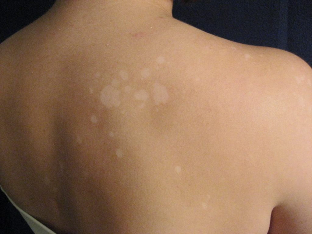 5 Mitos e Verdades sobre Micoses