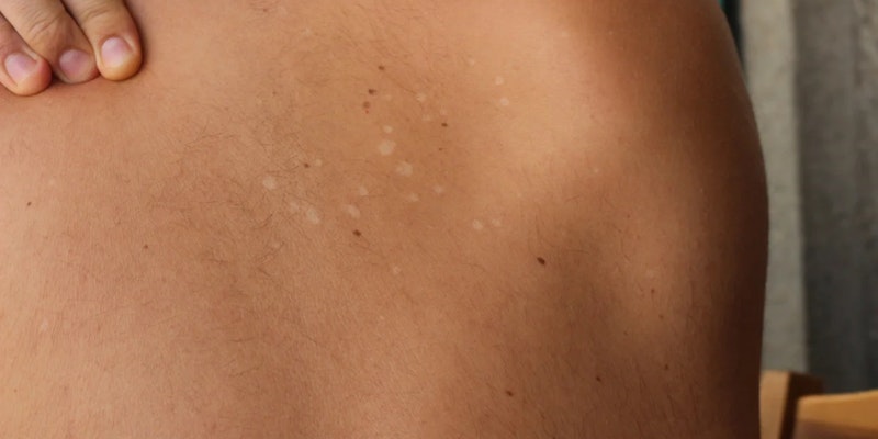 5 Mitos e Verdades sobre Micoses de Pele