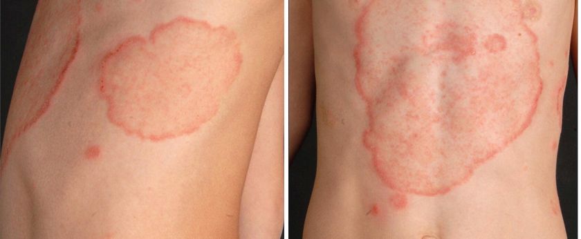 Como a Alimentação Afeta a Saúde da Pele e Micoses