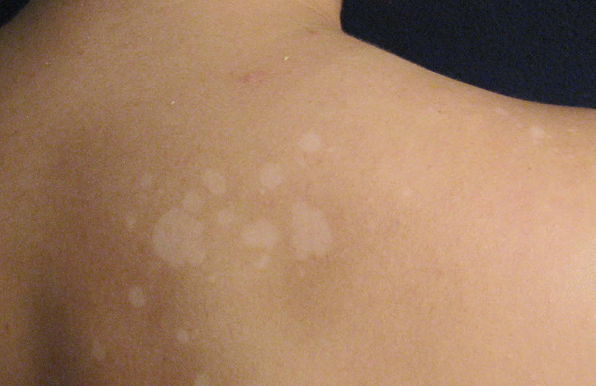 Guia Completo de Higiene para Prevenir Micoses